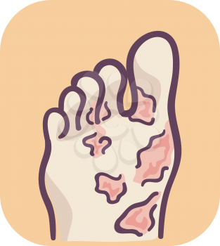 Illustration of Foot Blisters