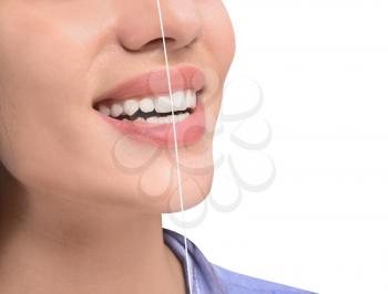 Young woman before and after procedure of gingival plasty on white background, closeup�