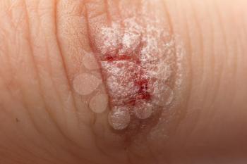 wound peroxidized