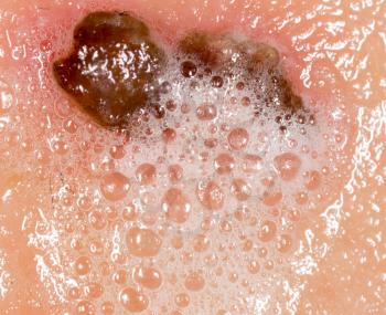 Wound on human skin in hydrogen peroxide. macro