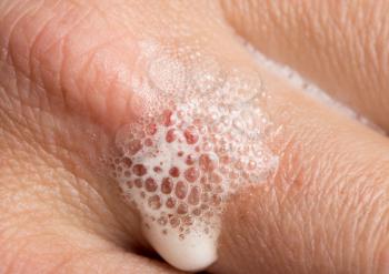 hydrogen peroxide on human skin. macro