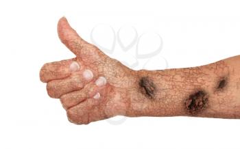 Old arm with cracks and rust, concept of getting old, giving the thumbs up sign, isolated on white