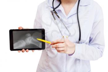 nurse points on tablet pc with X-ray photo of human knee joint on screen isolated on white background