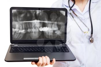 nurse holds computer laptop with X-ray picture of human jaw on screen isolated on white background