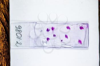 Slices of the tumor under glass. Histological examination of tumor cells for the presence of cancer. Samples of tumor cells under the sleek against the background of the lamp.