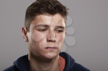 Teenage boy with acne looking down, head and shoulders portrait
