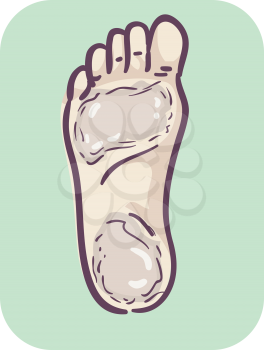 Illustration of Thickened Skin on Foot