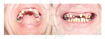 Royalty Free Photo of Two Views of a Man's Bad Teeth