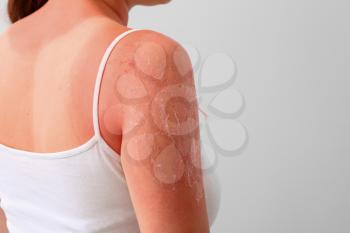 Woman with red sunburned skin against light background, closeup�