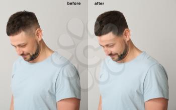 Man before and after hair loss treatment on grey background�