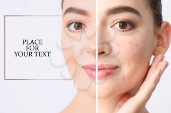 Young woman before and after acne treatment on light background with space for text�