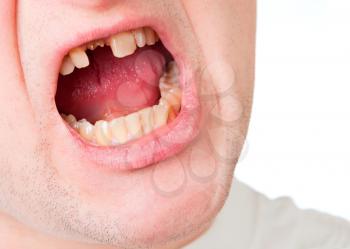 Royalty Free Photo of a Man's Mouth With a Broken Tooth