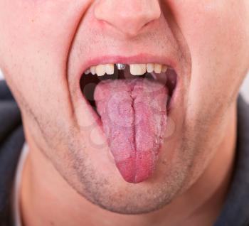 Young man face with broken tooth and tongue
