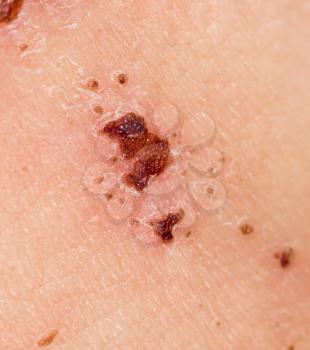 Wound on the skin of a person. macro