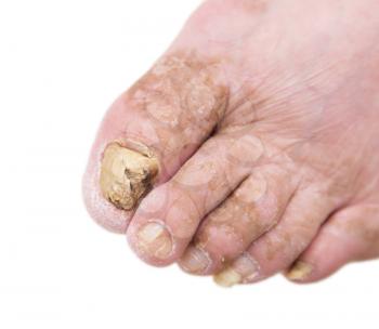 Fungus Infection on Nails of Man's Foot