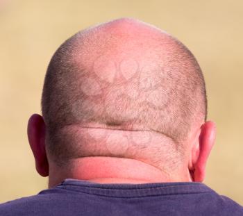 bald head on the man's head