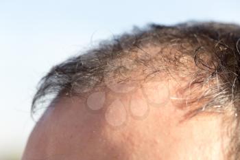 receding hairline in men