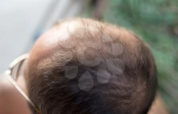 hair loss on the head of a man