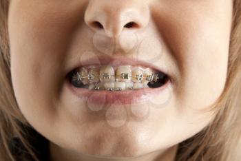 Royalty Free Photo of a Young Girl Showing Her Braces