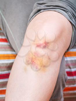 knee injury - bruise on leg close up