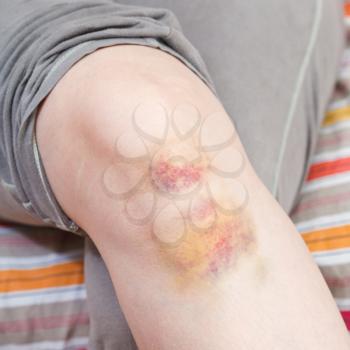 trauma of knee - bruise on leg close up
