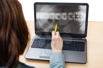 student analyzes X-ray picture of spine on laptop screen