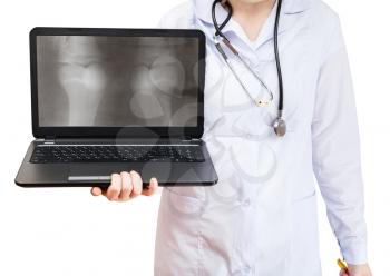 nurse holds computer laptop with X-ray picture of human knee joint on screen isolated on white background