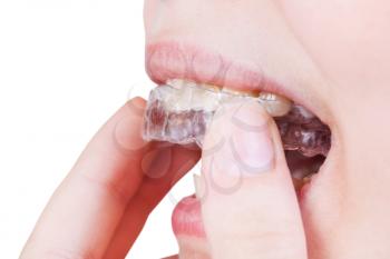 woman fixes clear aligner on teeth for orthodontic correction of bite isolated on white background