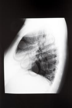 side view of human thorax with lungs on X-ray image