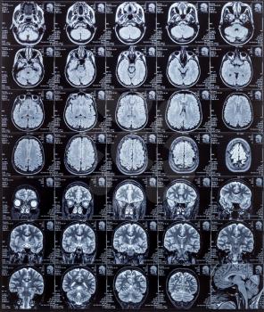 Magnetic resonance imaging photography of human brain