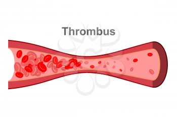 Blood clot in  blood vessel. Diseases of Veins in human body. Anatomical illustration of thrombosis. Blockage of blood vessels.

