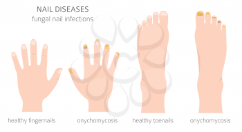 Nail diseases. Onychomycosis, nail fungal infection causes, treatment icon set. Medical infographic design.  Vector illustration