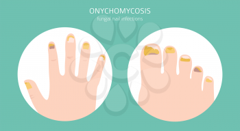 Nail diseases. Onychomycosis, nail fungal infection causes, treatment icon set. Medical infographic design.  Vector illustration