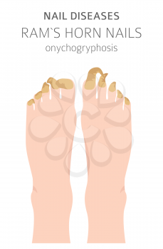 Nail diseases. Onychogryphosis, Ram`s horn nail. Medical infographic design.  Vector illustration