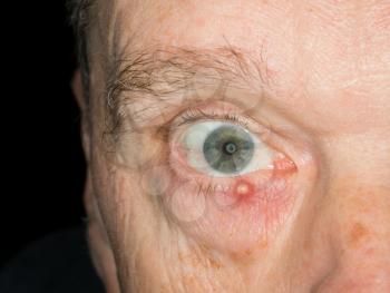 Macro image infected stye on the lower lid of a senior adult male eye