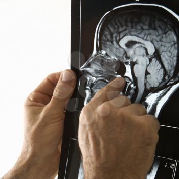 Mid-adult Caucasian male hands pointing at an x-ray.