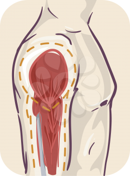 Illustration of Side of a Person Showing Shrinking Muscle. Atrophy