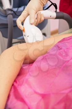 Laser epilation or photo epilation of woman hand