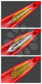 Atherosclerosis Clipart