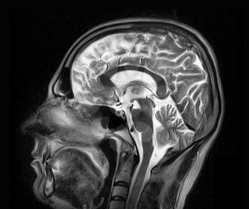 Magnetic resonance imaging of the brain with no visible abnormalities.