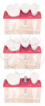 Royalty Free Photo of Dental Models With Different Types of Treatments