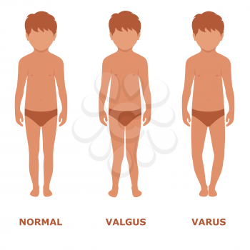 valgus, varus knee, legs disease, foot illustration