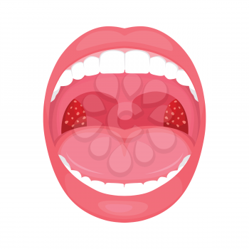  vector illustration of a throat bacterial and viral infection, tonsils inflammation.