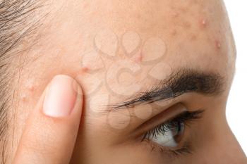 Young woman with acne problem, closeup�