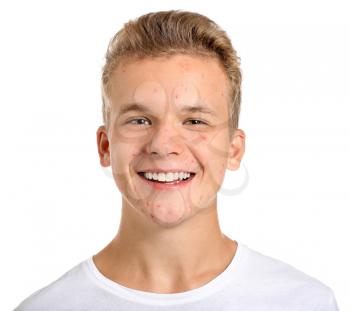 Teenage boy with acne problem on white background�