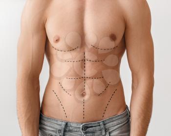 Young man with marks on his body against light background. Plastic surgery concept�