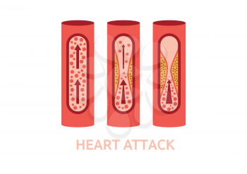 heart attack symptoms coronary arteries disease medicine healthcare vector illustration