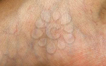 varicose veins on the skin. Macro