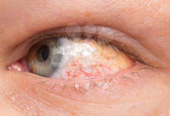 Chronic conjunctivitis eye with a red iris and pus close-up.