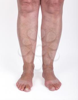 Old woman with varicose veins, isolated on white